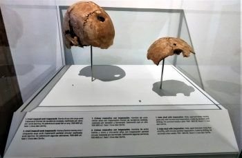 Cráneo trepanado Cráneo trepanado